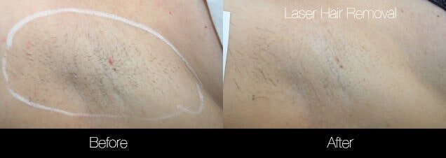 Bikini Laser Hair Removal Pain Ingrown hairs  Styles  YouTube