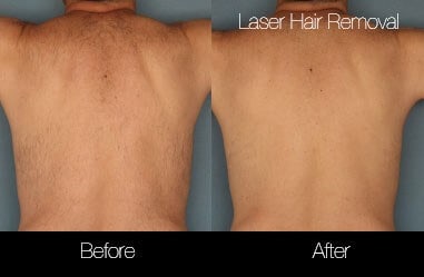 GentleMax Pro Treatment in Toronto | SpaMedica GentleMax Pro Treatment in Toronto | SpaMedica