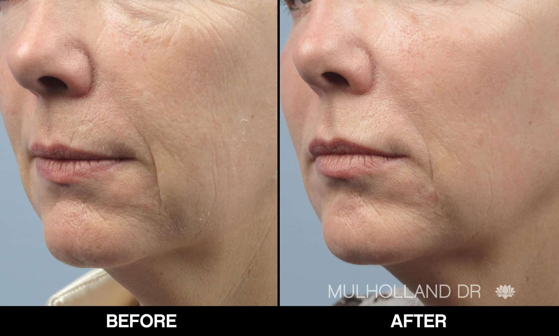 Laser Skin Resurfacing - Before and After Gallery – Photo 68