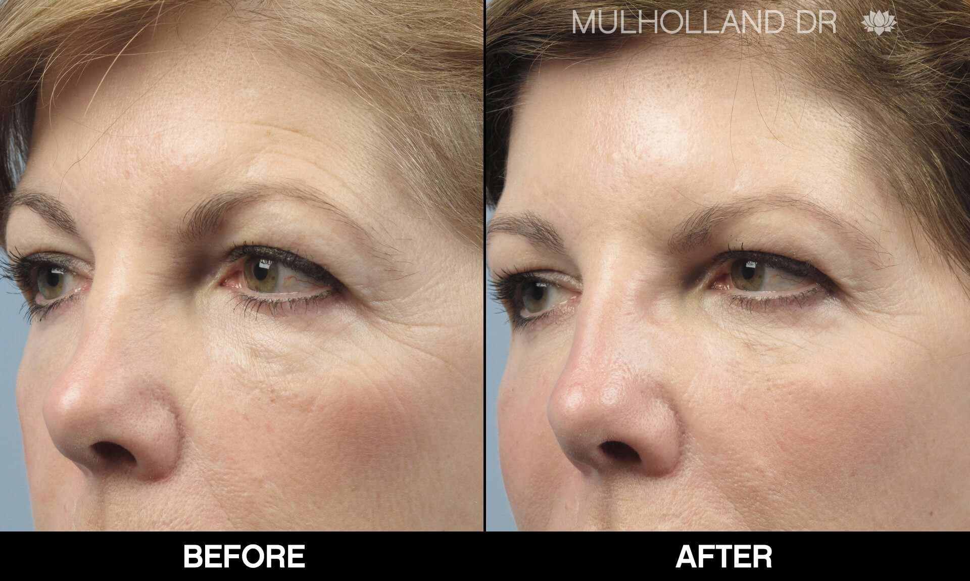 Laser Skin Resurfacing - Before and After Gallery – Photo 69