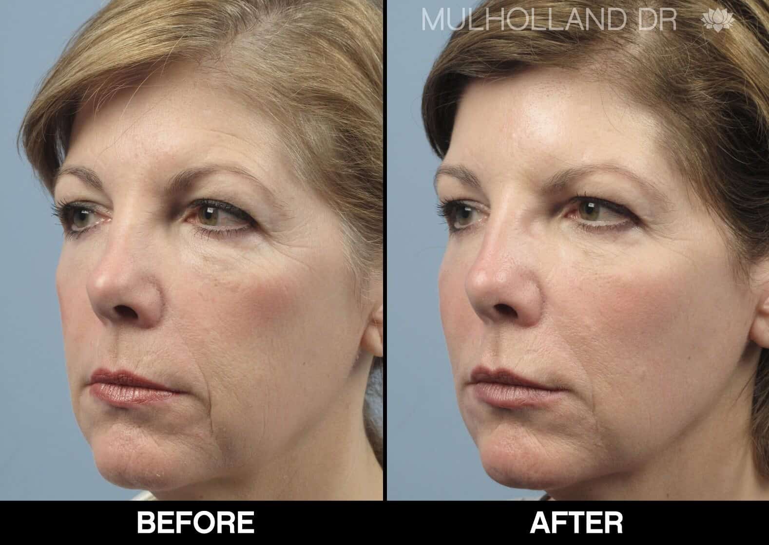 Laser Skin Resurfacing - Before and After Gallery – Photo 71