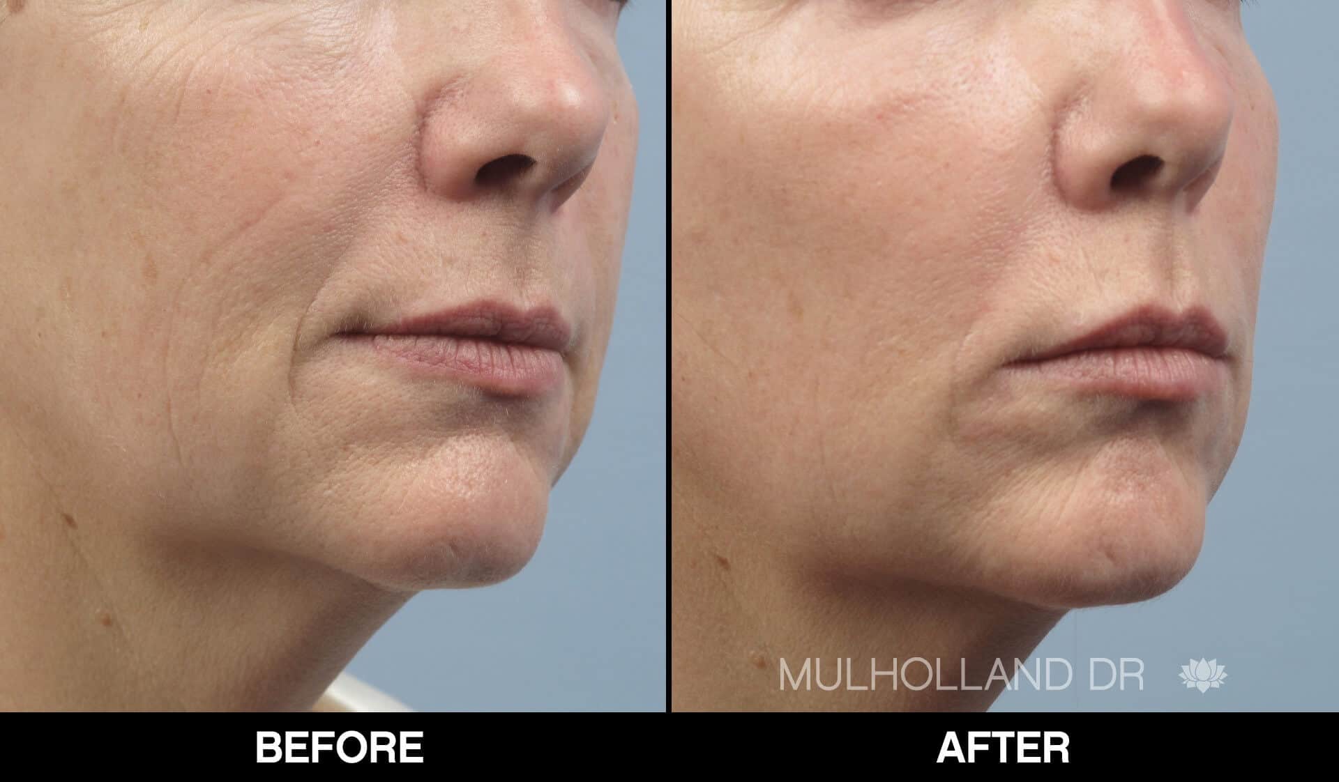 Laser Skin Resurfacing - Before and After Gallery – Photo 72