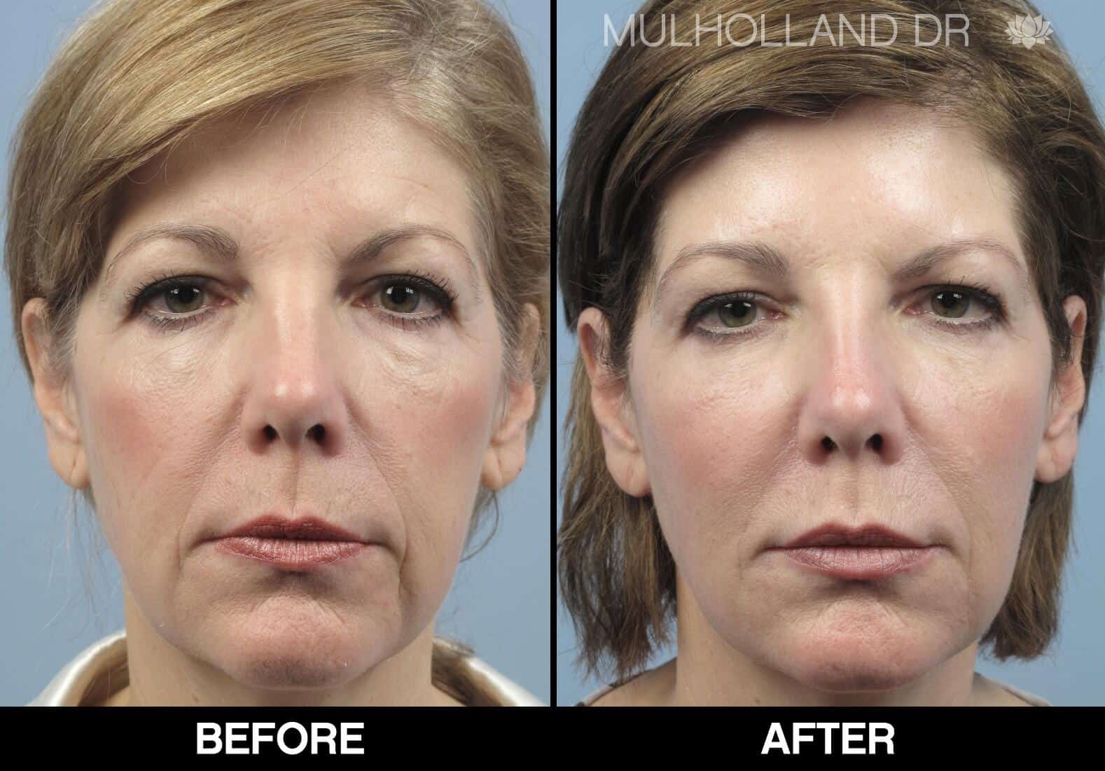 Laser Skin Resurfacing - Before and After Gallery – Photo 79
