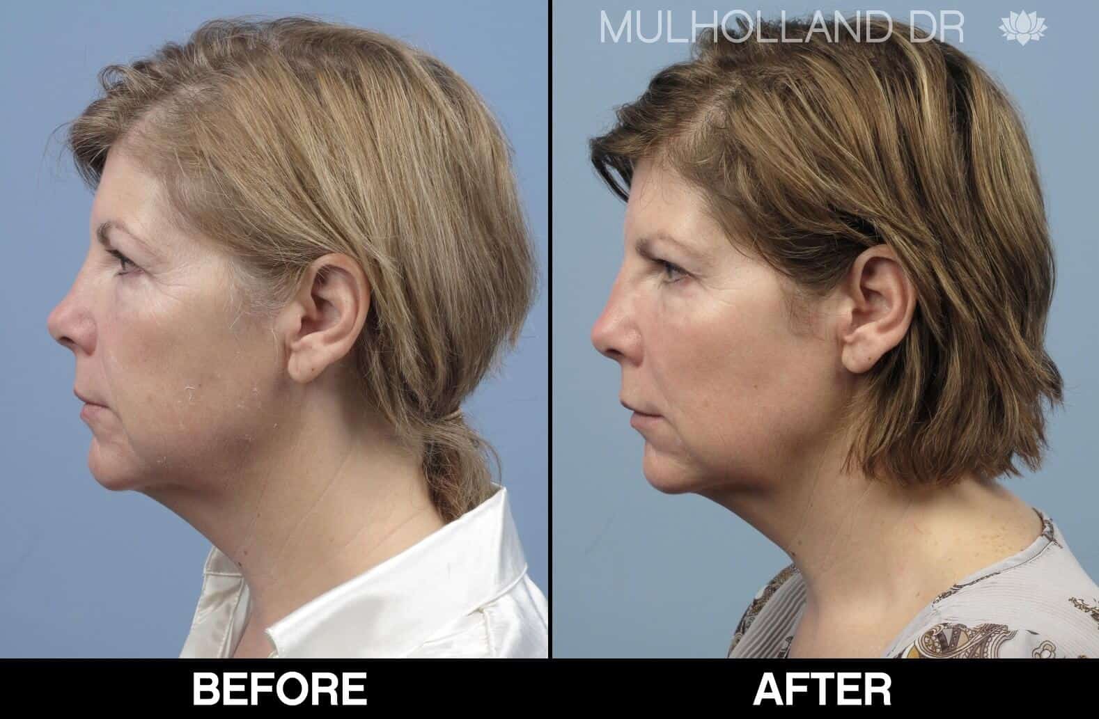 Laser Skin Resurfacing - Before and After Gallery – Photo 80