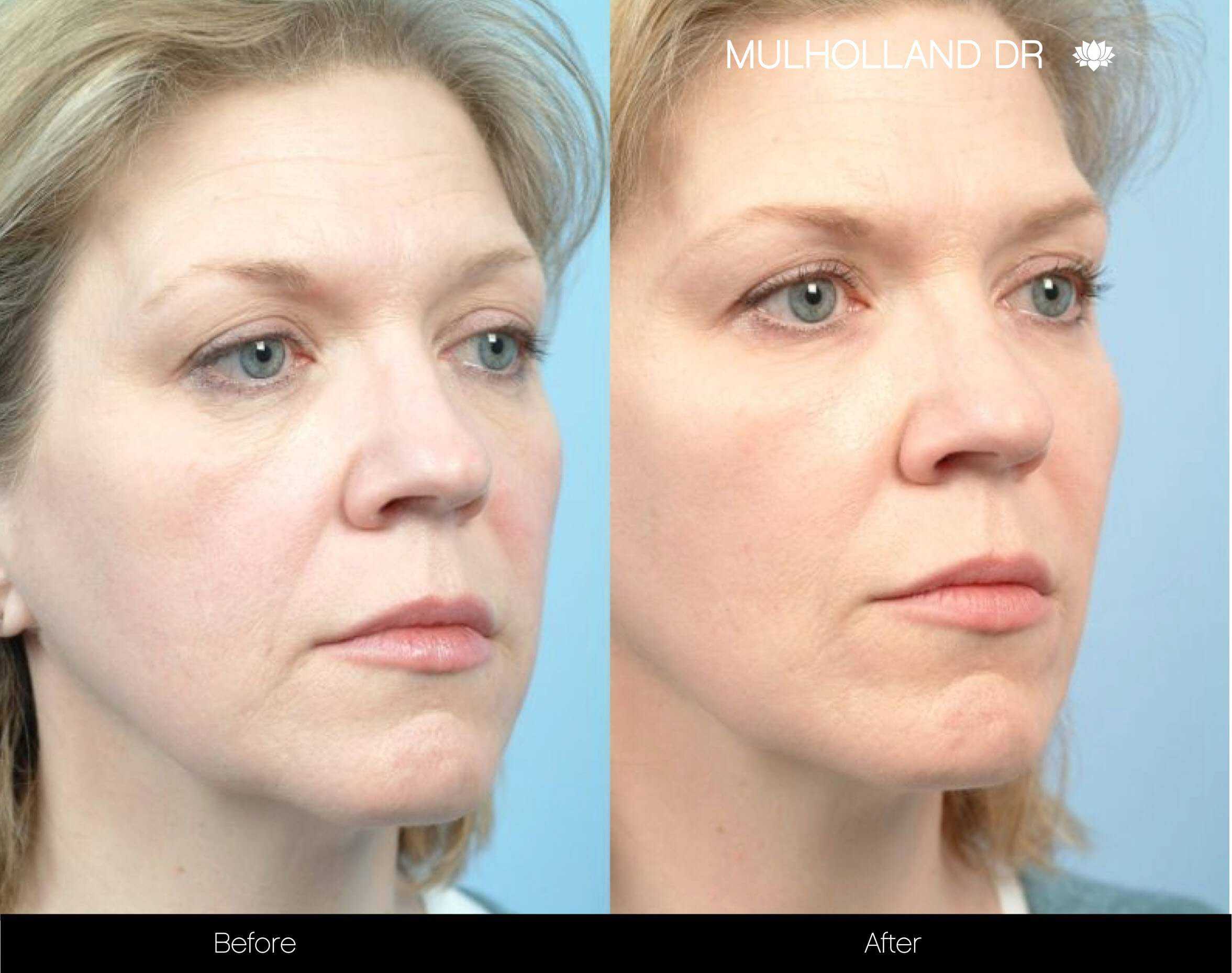 Laser Skin Tightening Before And After