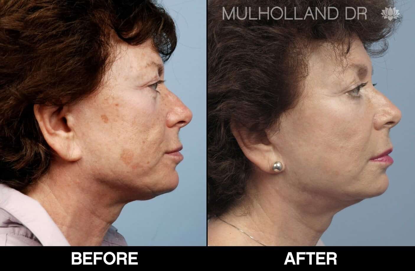 Laser Skin Resurfacing - Before and After Gallery – Photo 58
