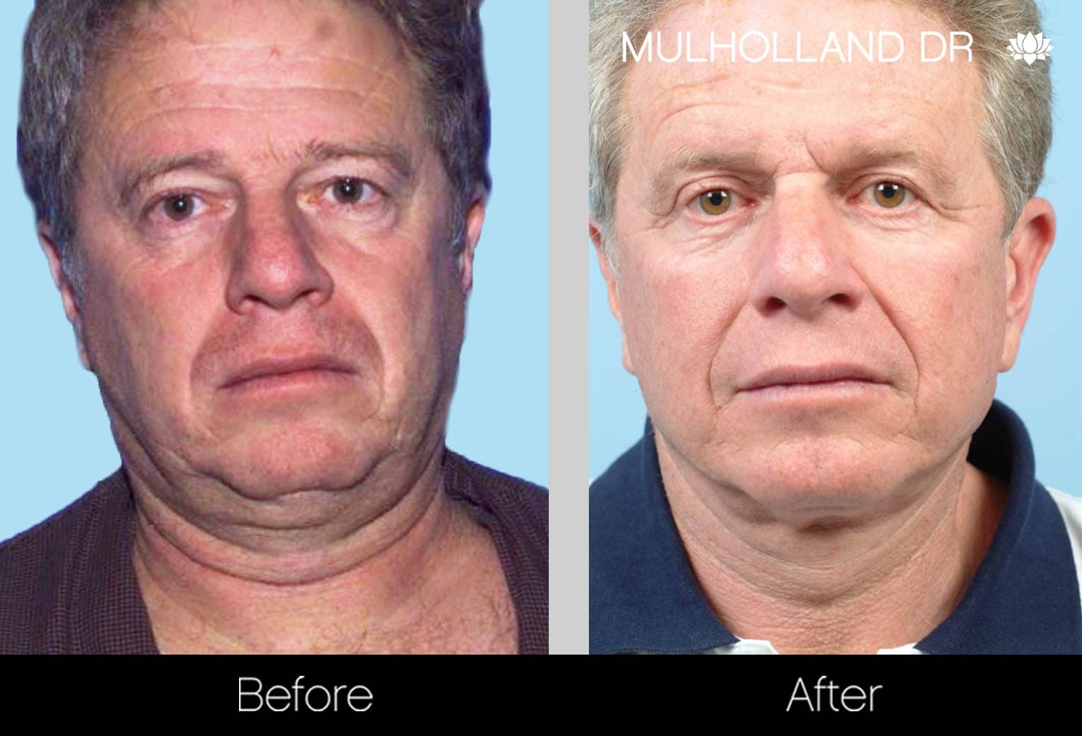 Tumescent Liposuction - Before and After Gallery – Photo 120
