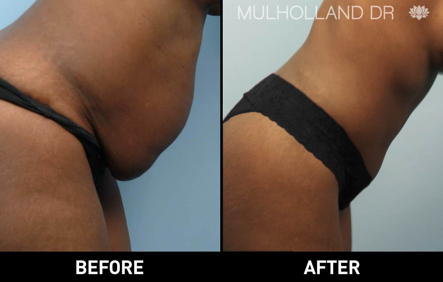 Tumescent Liposuction - Before and After Gallery – Photo 11