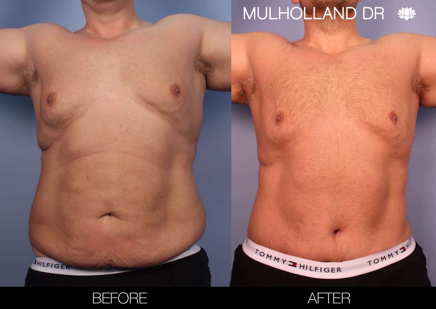 Male Tummy Tuck (Belt Lipectomy) - Before and After Gallery – Photo 21