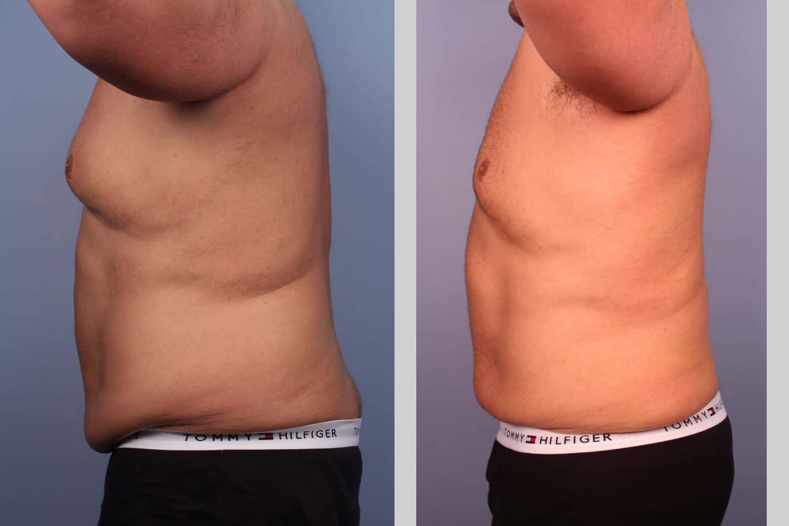 Male Tummy Tuck (Belt Lipectomy) - Before and After Gallery – Photo 22