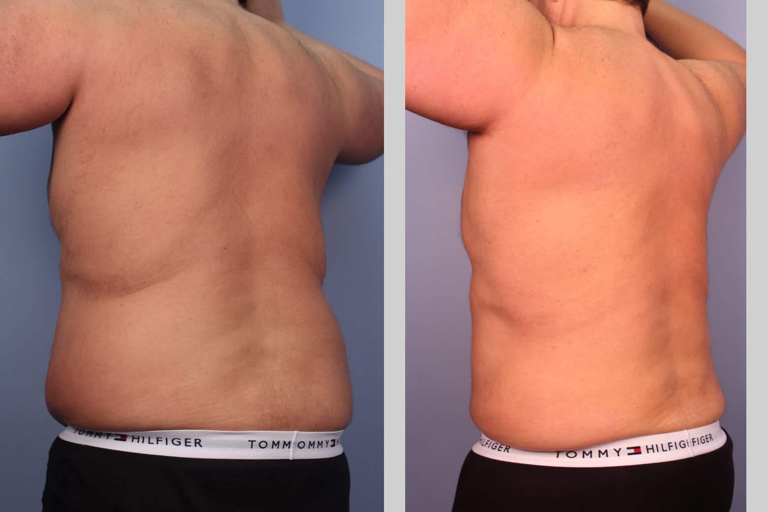 Male Tummy Tuck (Belt Lipectomy) - Before and After Gallery – Photo 23