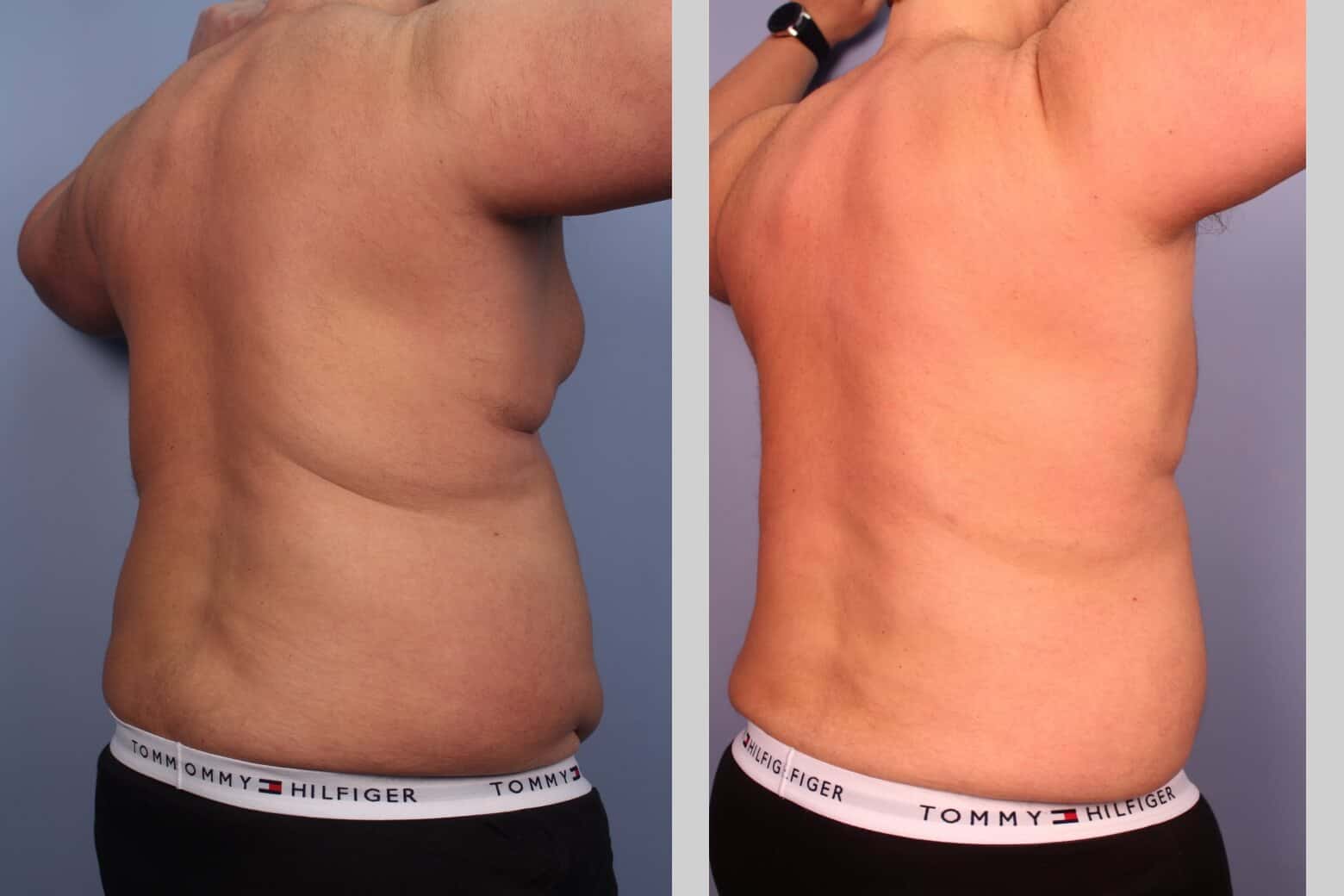 Male Tummy Tuck (Belt Lipectomy) - Before and After Gallery – Photo 24