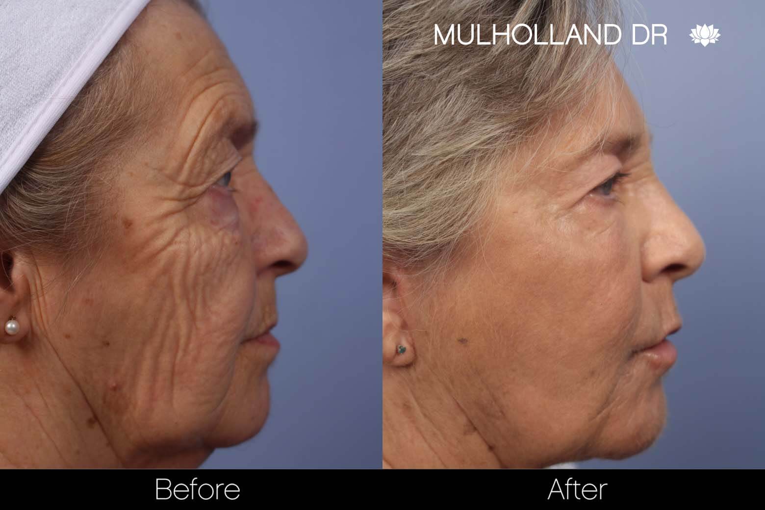 Facial Fat Transfer - Before and After Gallery – Photo 15