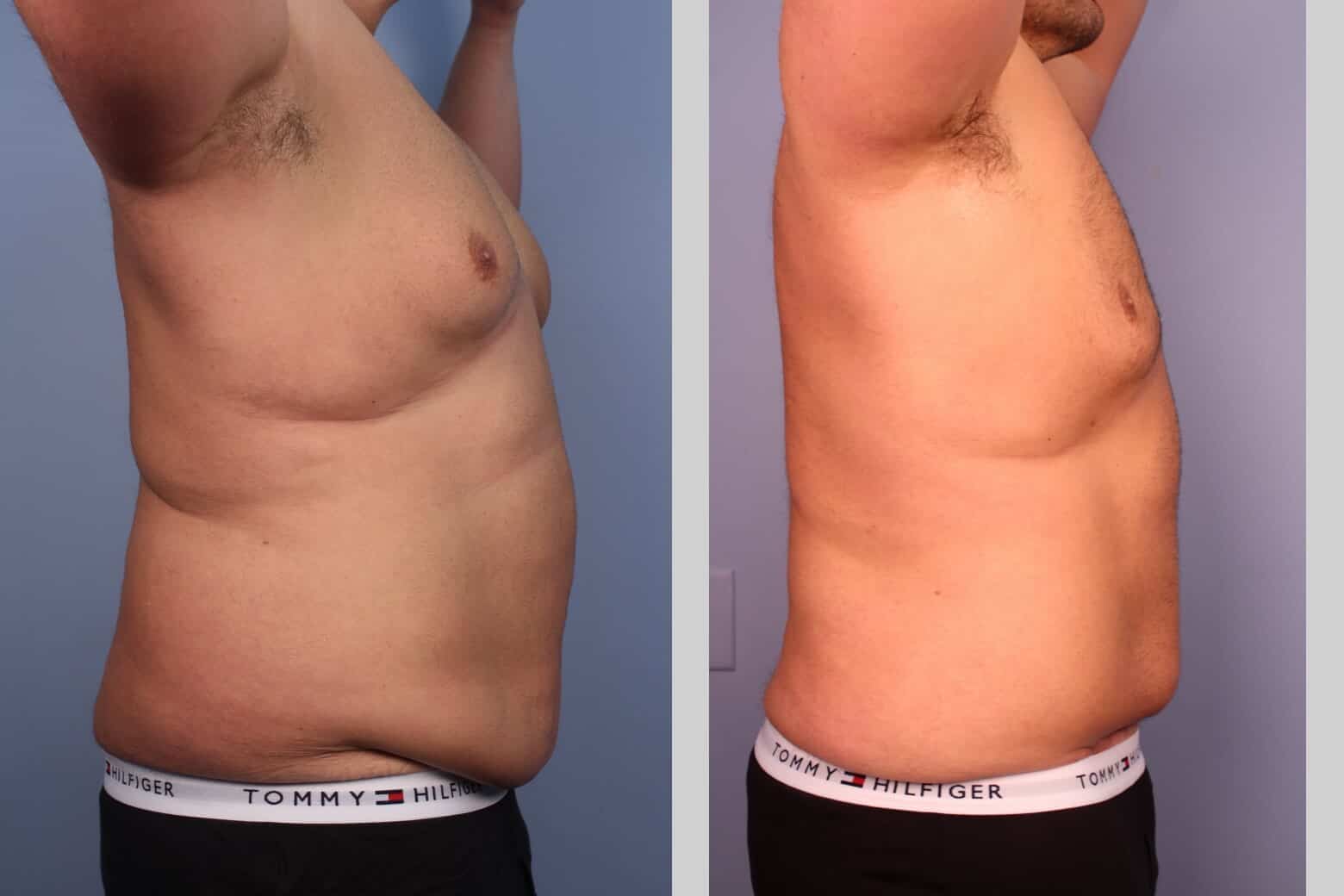 Male Tummy Tuck (Belt Lipectomy) - Before and After Gallery – Photo 25