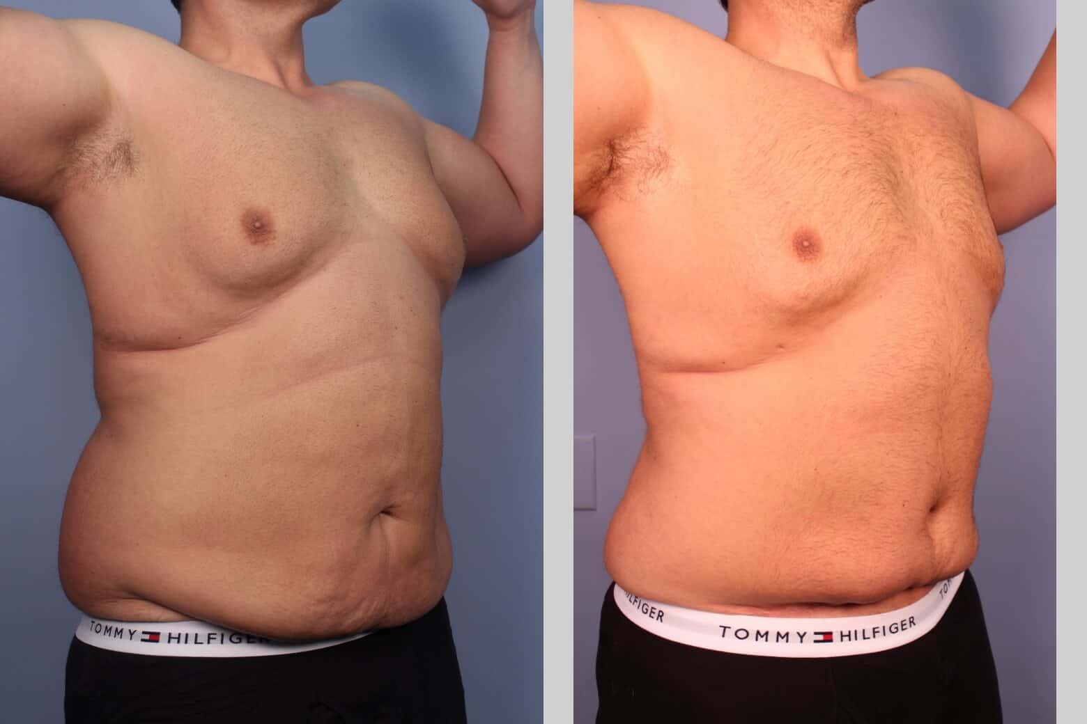 Male Tummy Tuck (Belt Lipectomy) - Before and After Gallery – Photo 26