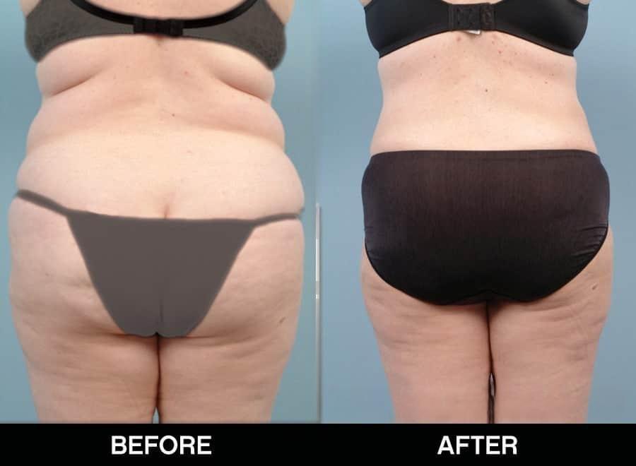 Tumescent Liposuction - Before and After Gallery – Photo 18