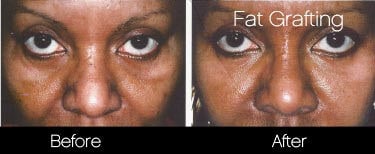 Facial Fat Transfer - Before and After Gallery – Photo 17