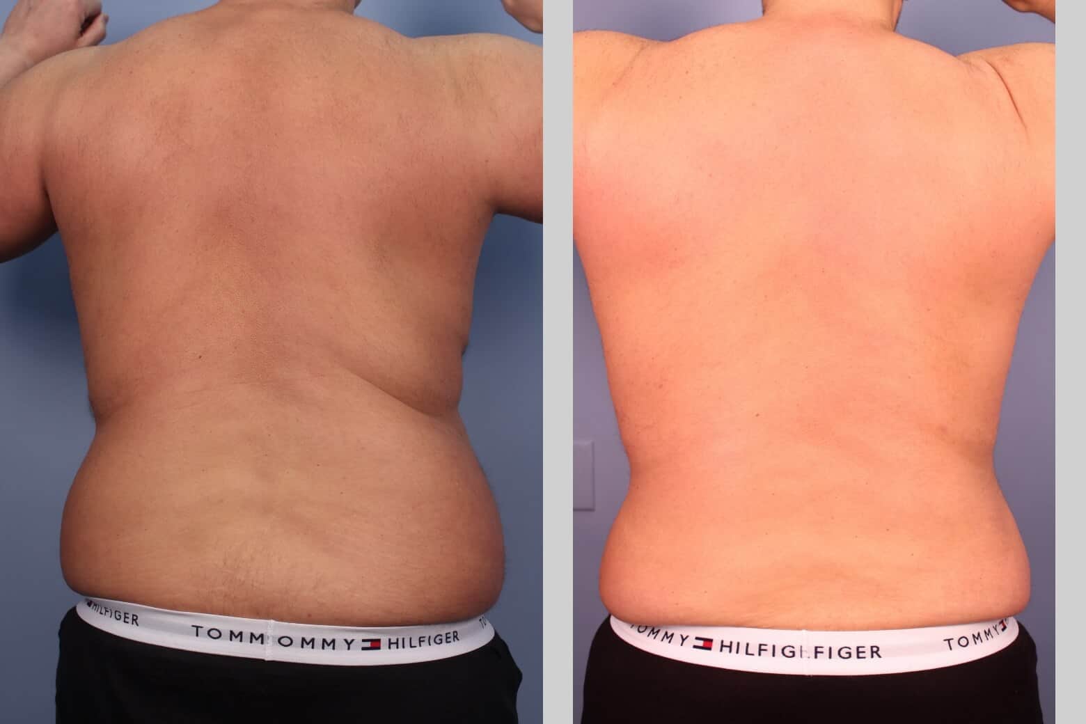 Male Tummy Tuck (Belt Lipectomy) - Before and After Gallery – Photo 27