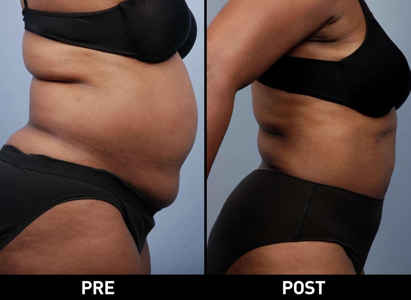 Tumescent Liposuction - Before and After Gallery – Photo 19