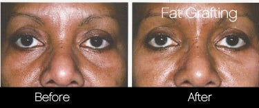 Facial Fat Transfer - Before and After Gallery – Photo 18