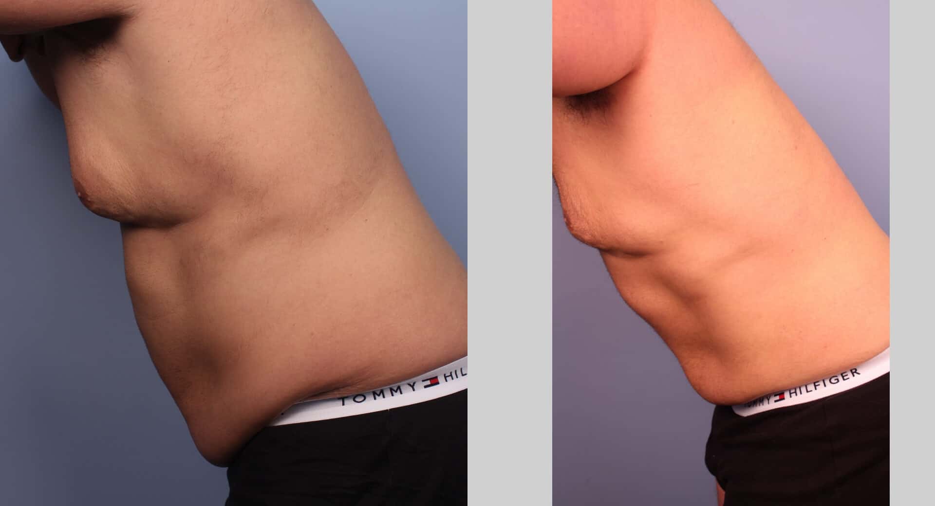 Male Tummy Tuck (Belt Lipectomy) - Before and After Gallery – Photo 28