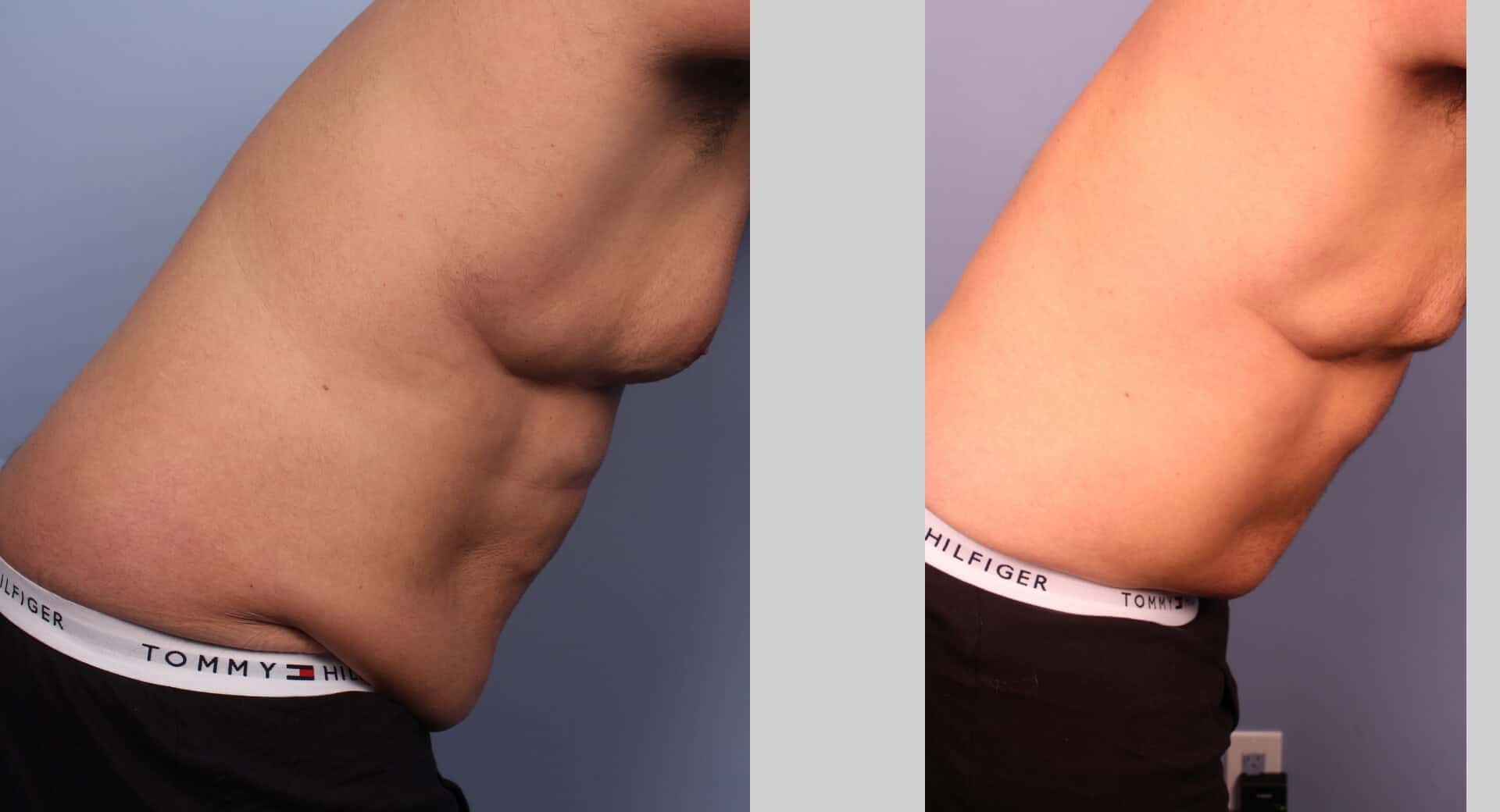 Male Tummy Tuck (Belt Lipectomy) - Before and After Gallery – Photo 29