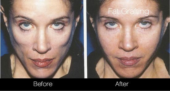 Facial Fat Transfer - Before and After Gallery – Photo 20
