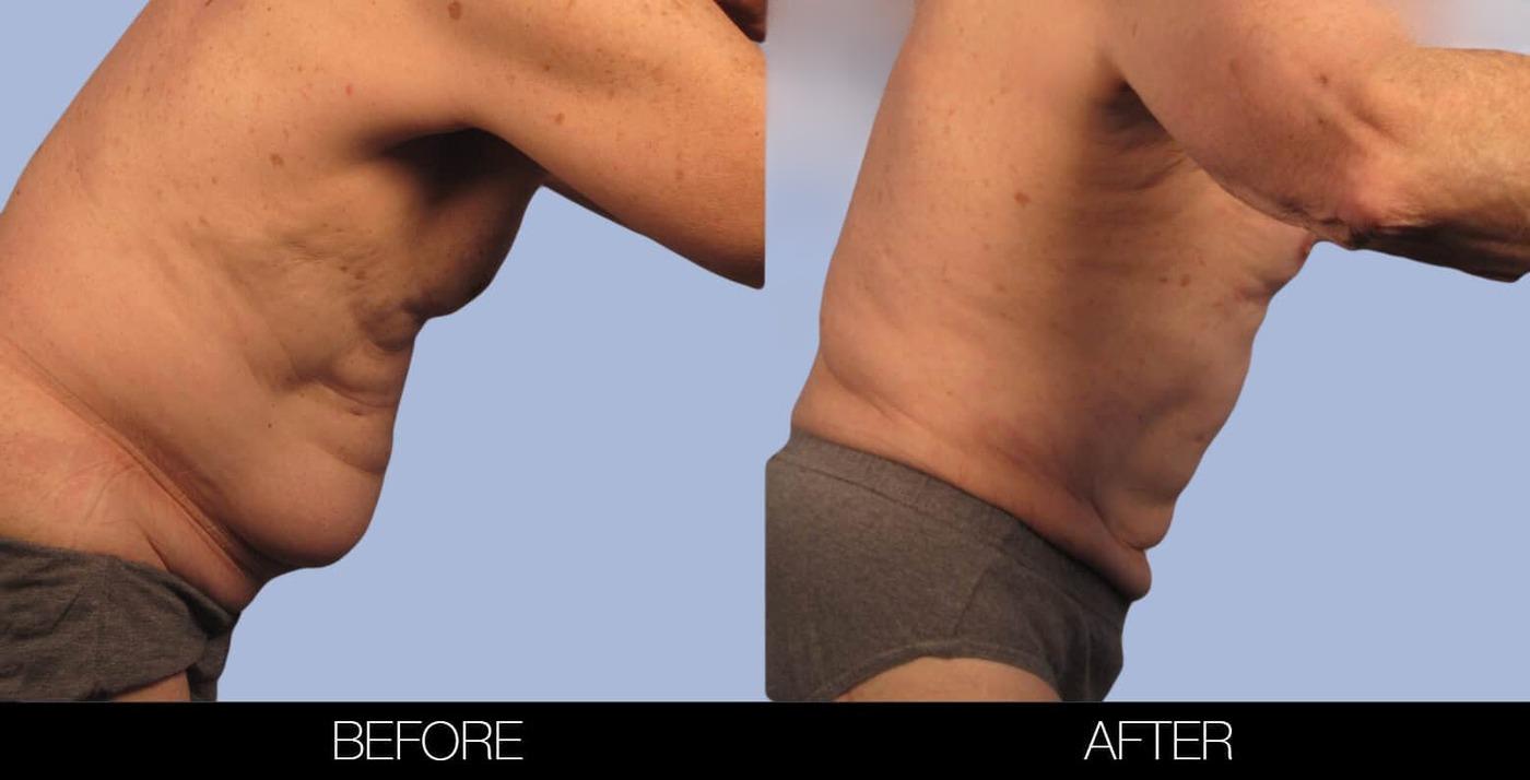 Male Tummy Tuck (Belt Lipectomy) - Before and After Gallery – Photo 30