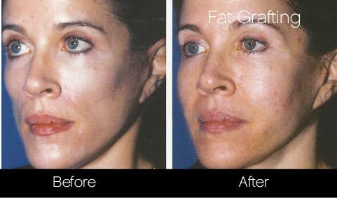 Facial Fat Transfer - Before and After Gallery – Photo 21