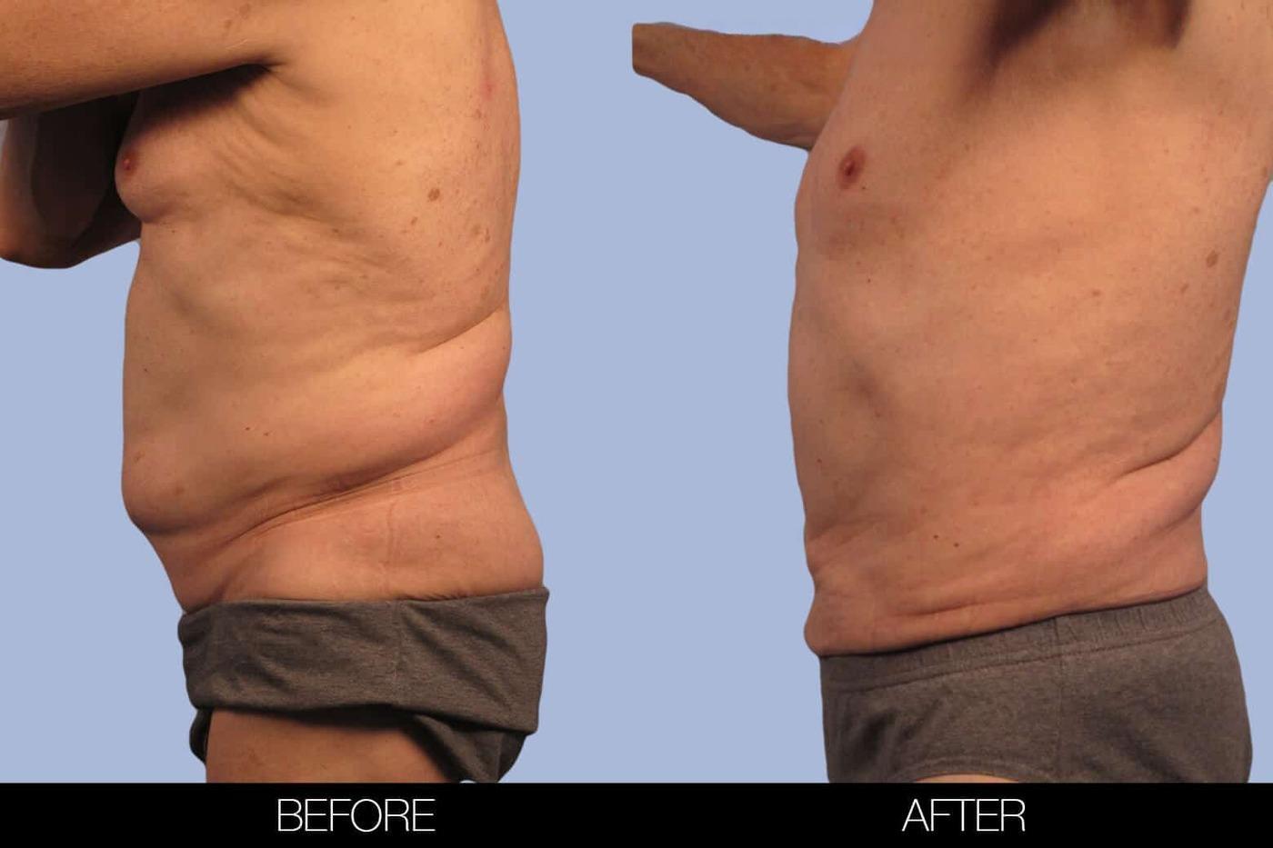 Male Tummy Tuck (Belt Lipectomy) - Before and After Gallery – Photo 31