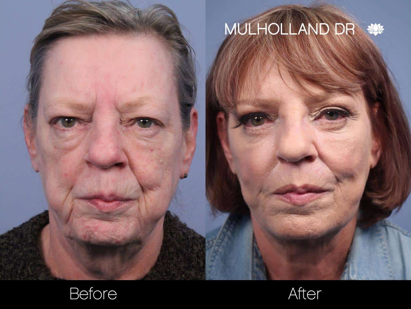 Facial Fat Transfer - Before and After Gallery – Photo 22