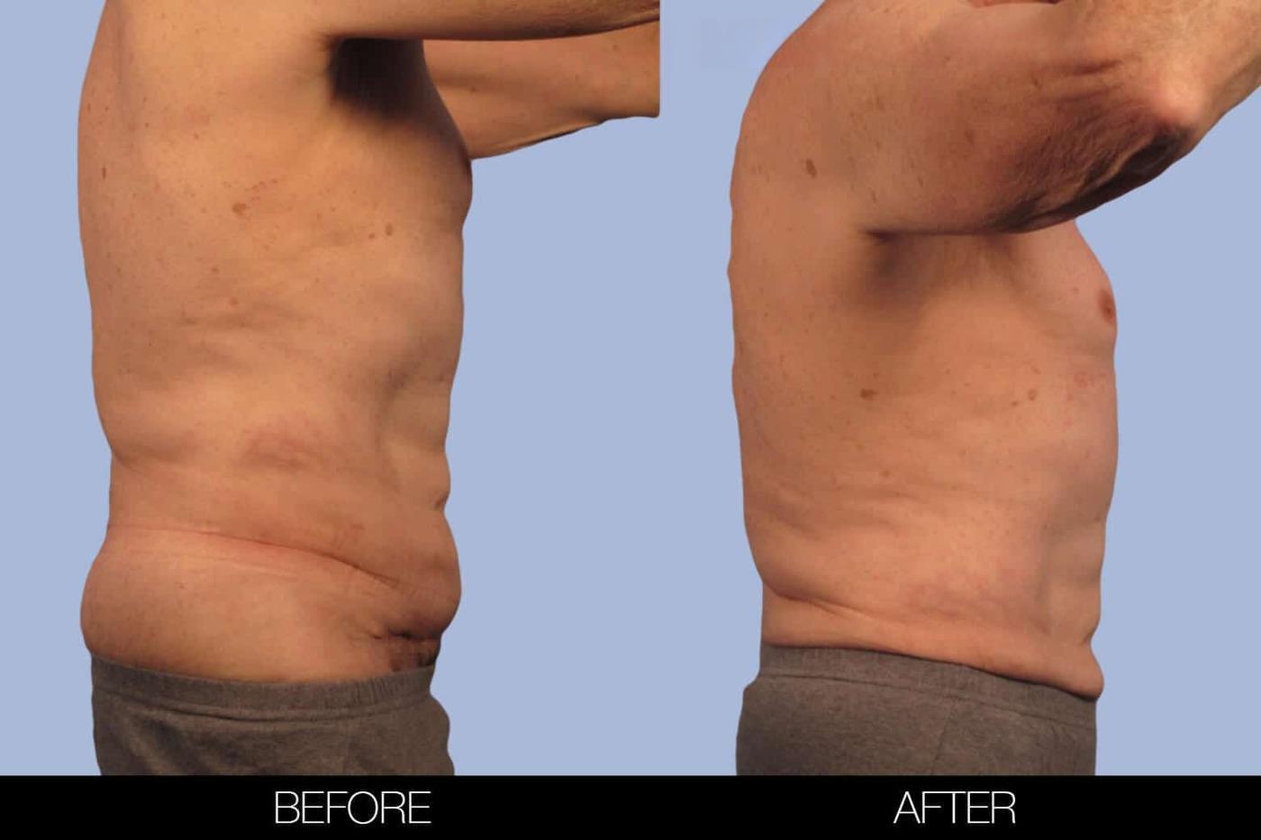 Male Tummy Tuck (Belt Lipectomy) - Before and After Gallery – Photo 32