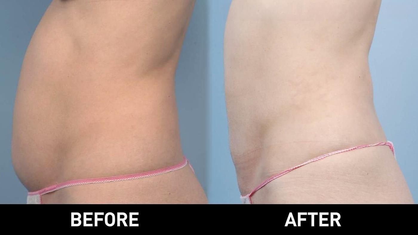 Tumescent Liposuction - Before and After Gallery – Photo 24