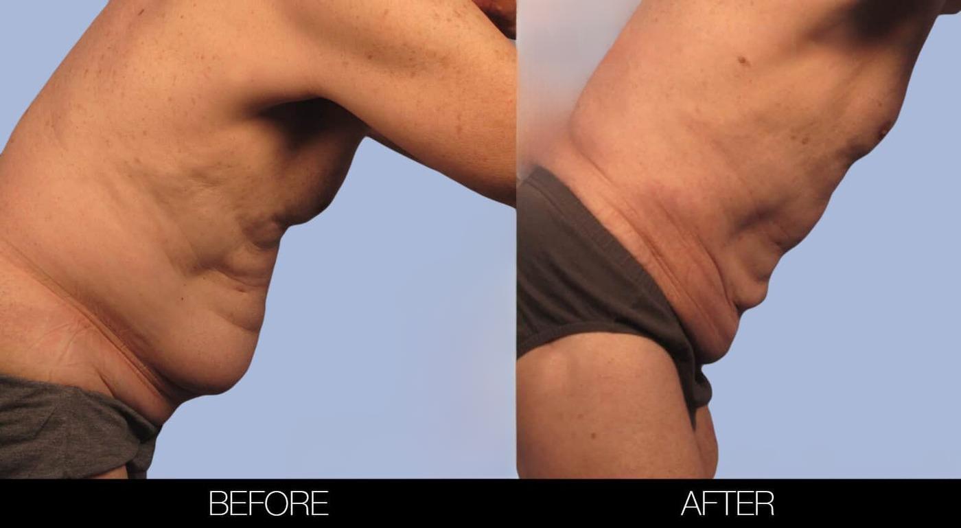 Male Tummy Tuck (Belt Lipectomy) - Before and After Gallery – Photo 33