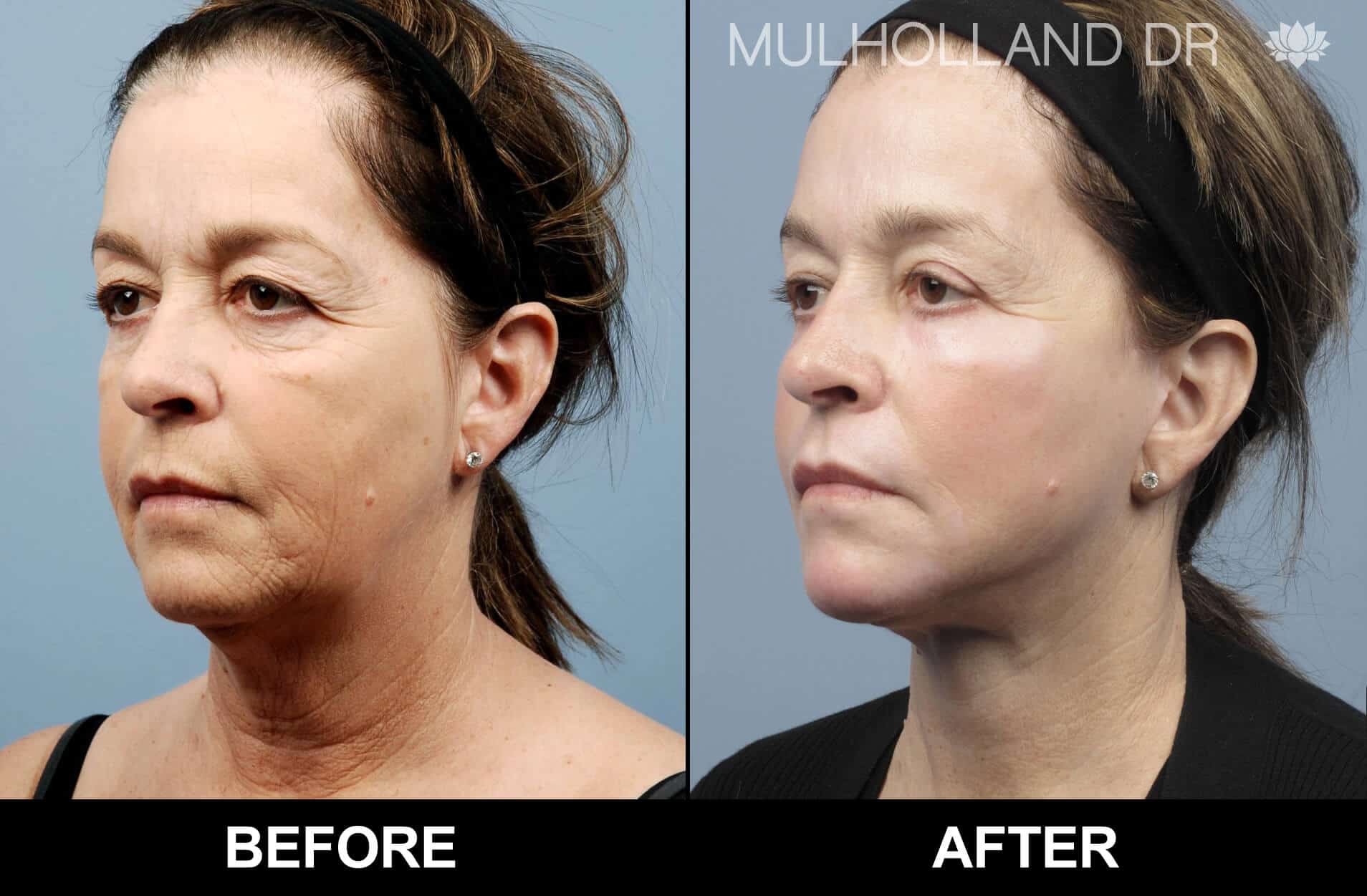 Facial Fat Transfer - Before and After Gallery – Photo 25