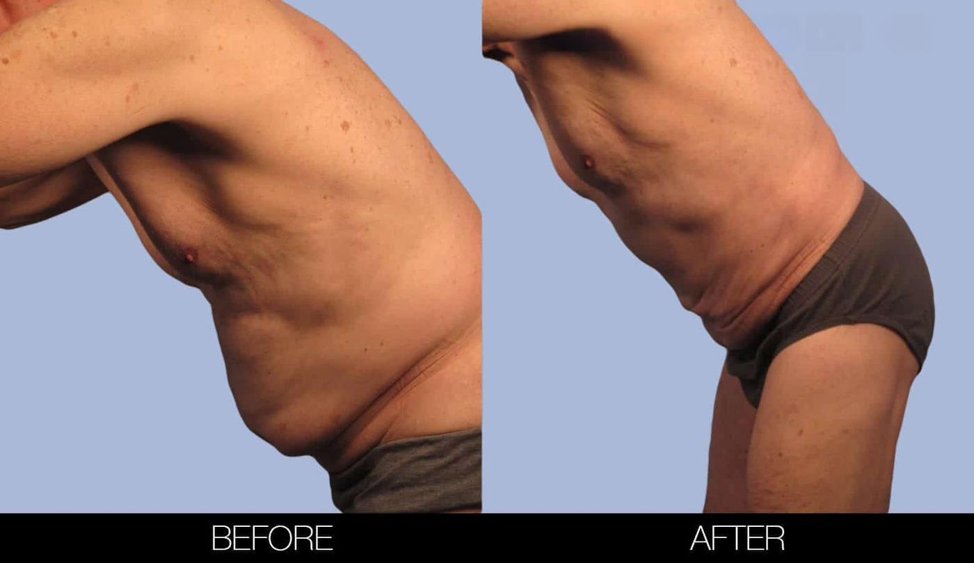 Male Tummy Tuck (Belt Lipectomy) - Before and After Gallery – Photo 34