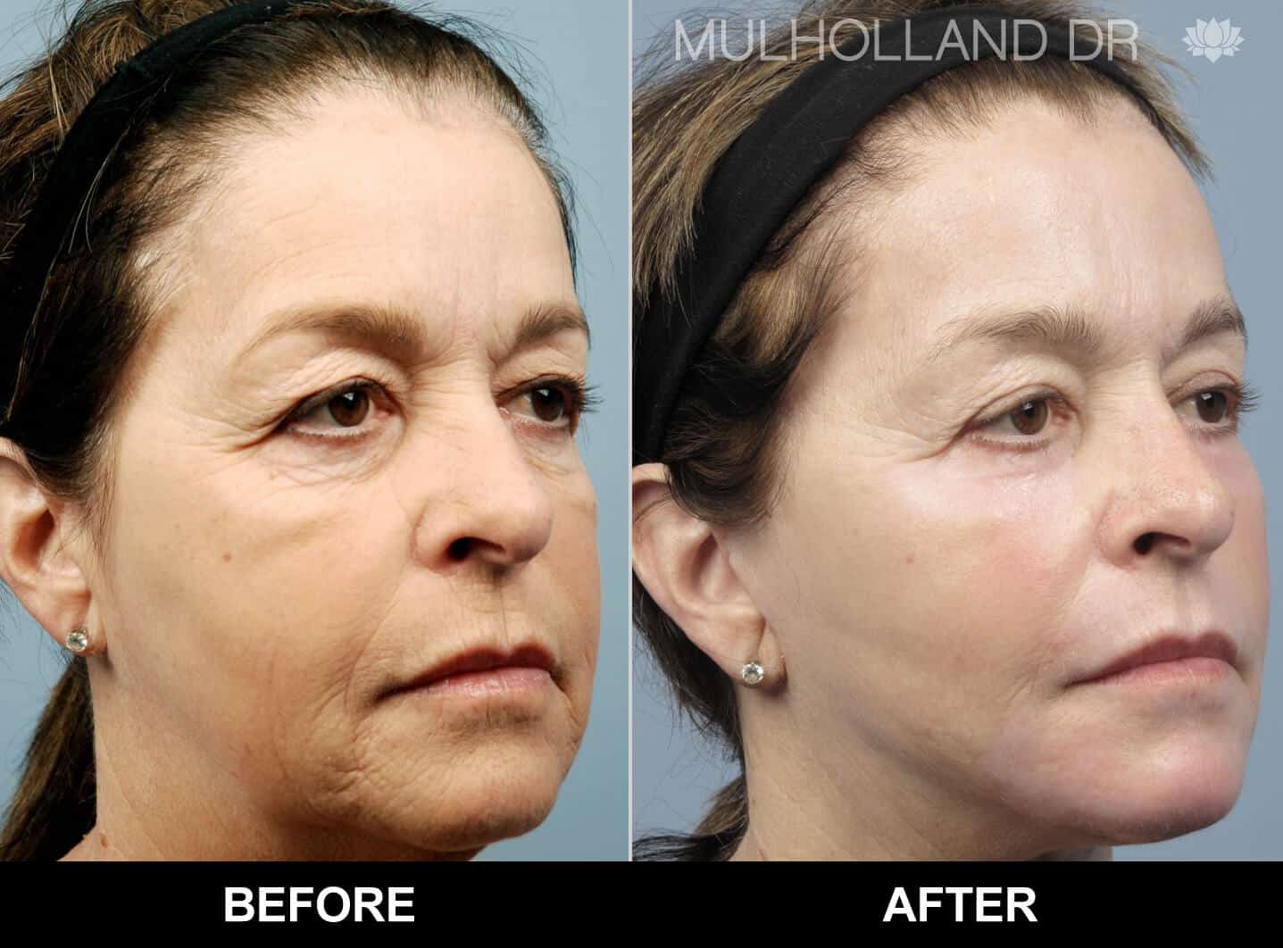 Facial Fat Transfer - Before and After Gallery – Photo 26