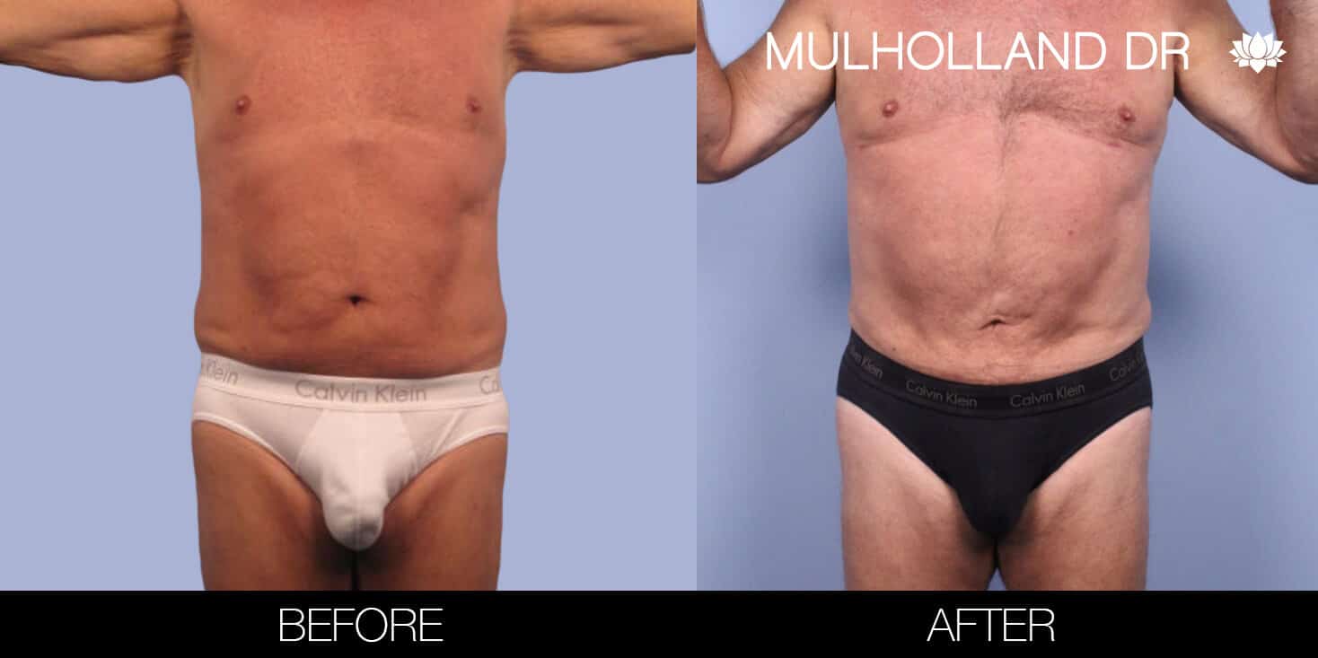 Male Tummy Tuck (Belt Lipectomy) - Before and After Gallery – Photo 36