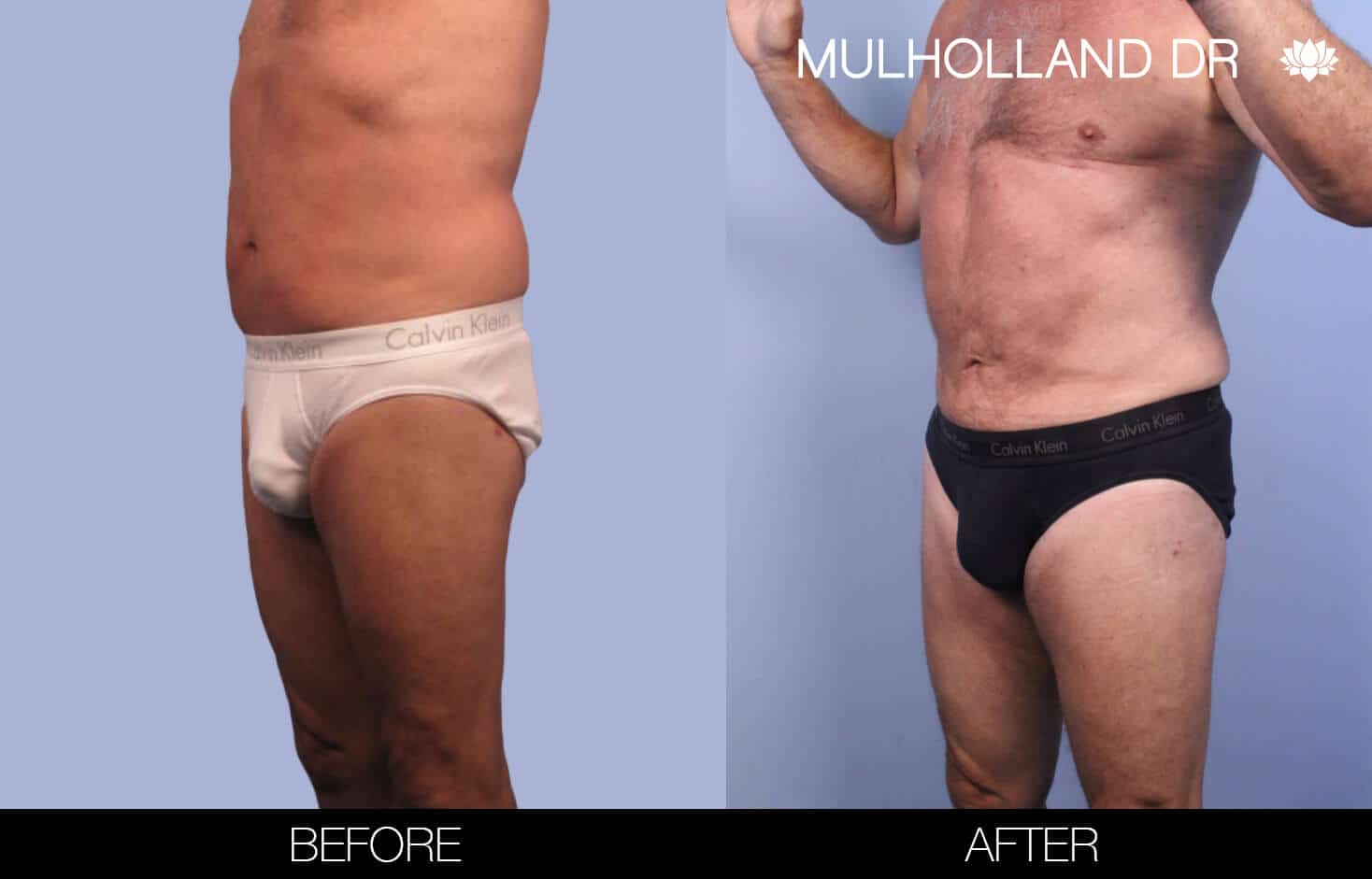 Male Tummy Tuck (Belt Lipectomy) - Before and After Gallery – Photo 37
