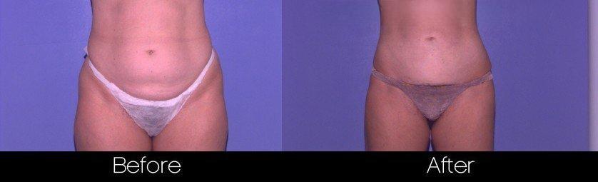 Tumescent Liposuction - Before and After Gallery – Photo 37
