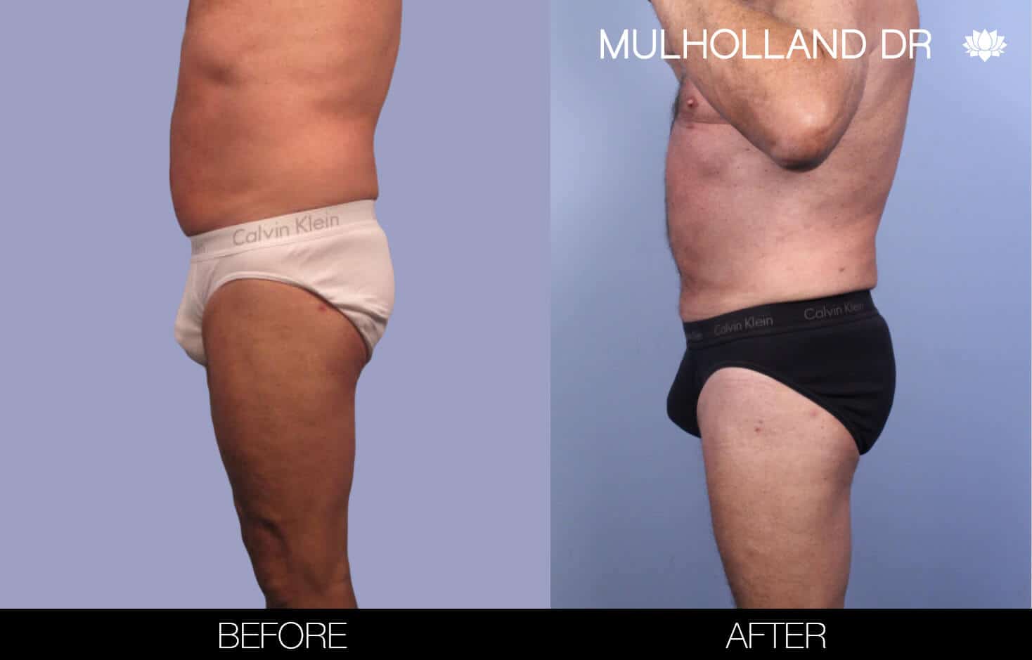 Male Tummy Tuck (Belt Lipectomy) - Before and After Gallery – Photo 38