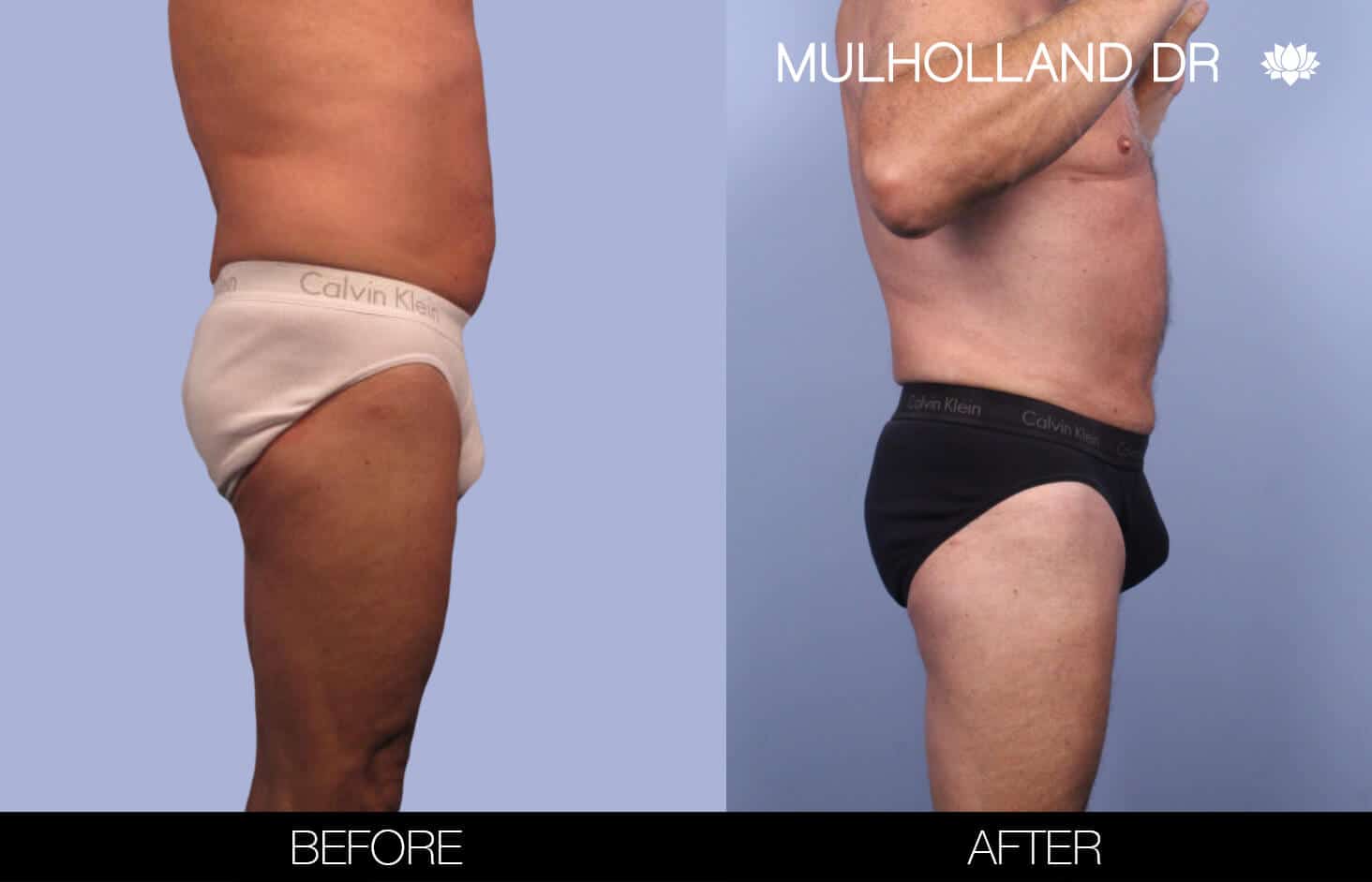 Male Tummy Tuck (Belt Lipectomy) - Before and After Gallery – Photo 39
