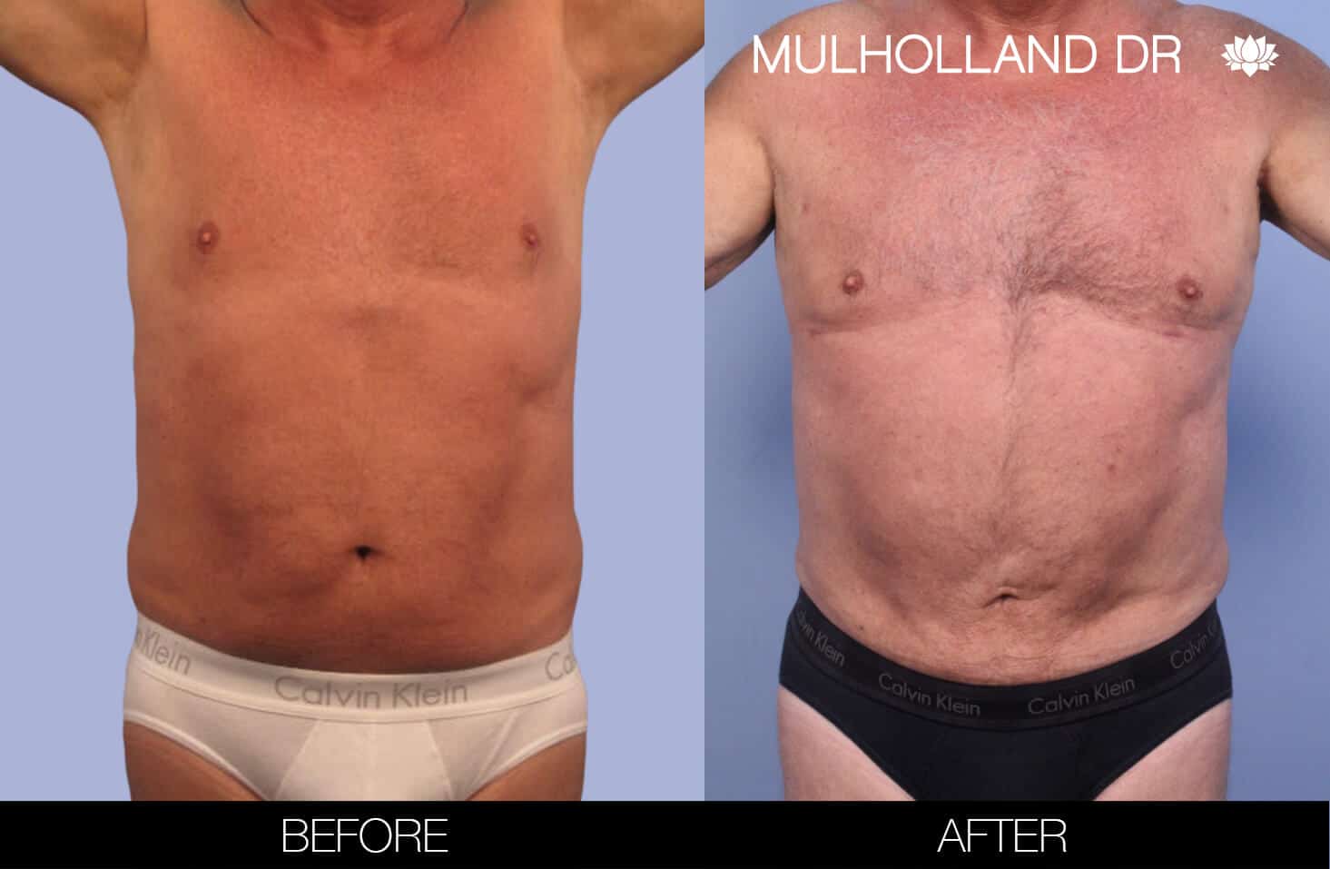 Male Tummy Tuck (Belt Lipectomy) - Before and After Gallery – Photo 40