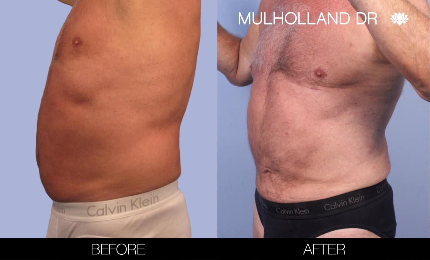 Male Tummy Tuck (Belt Lipectomy) - Before and After Gallery – Photo 41