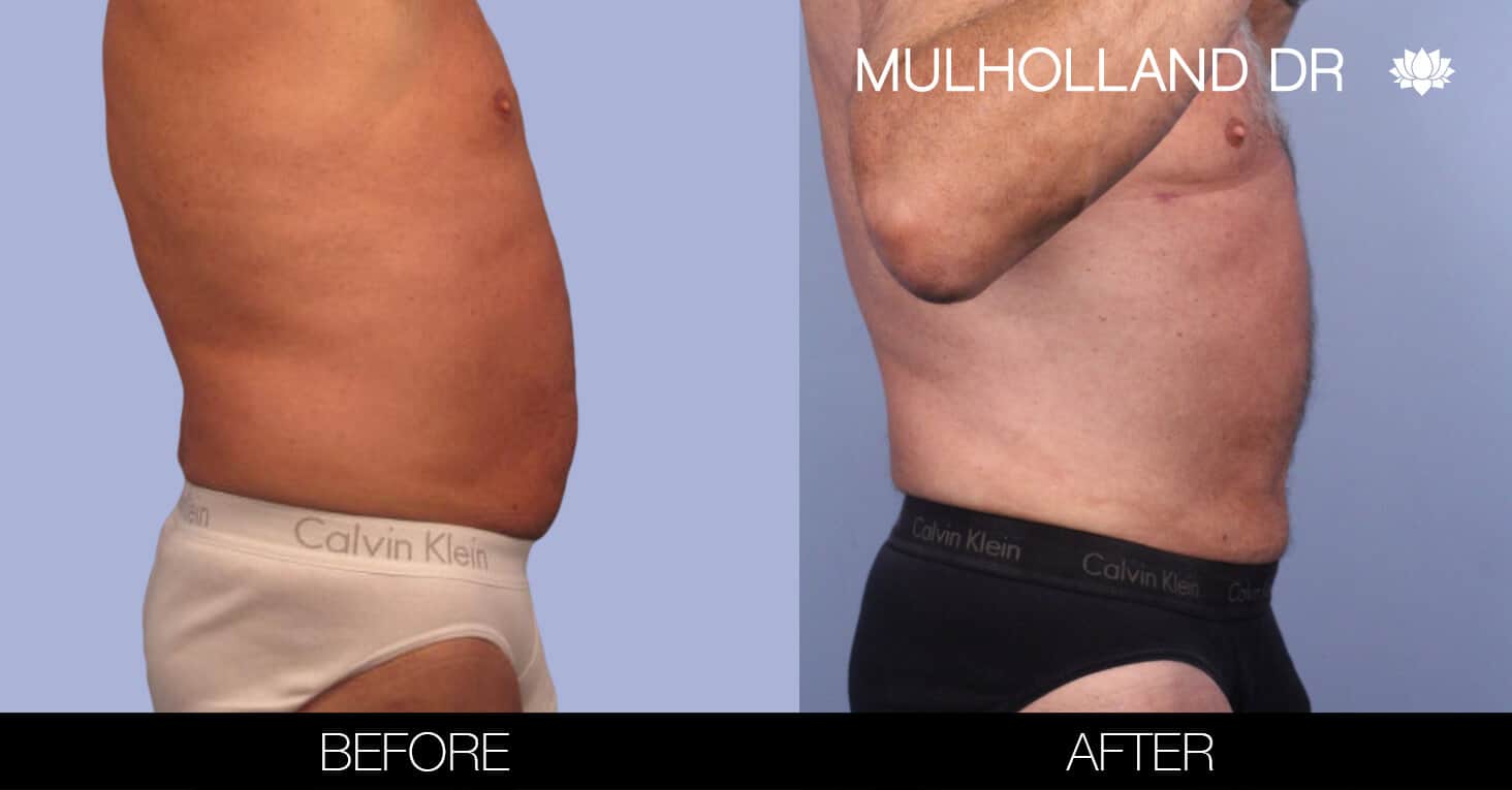 Male Tummy Tuck (Belt Lipectomy) - Before and After Gallery – Photo 42