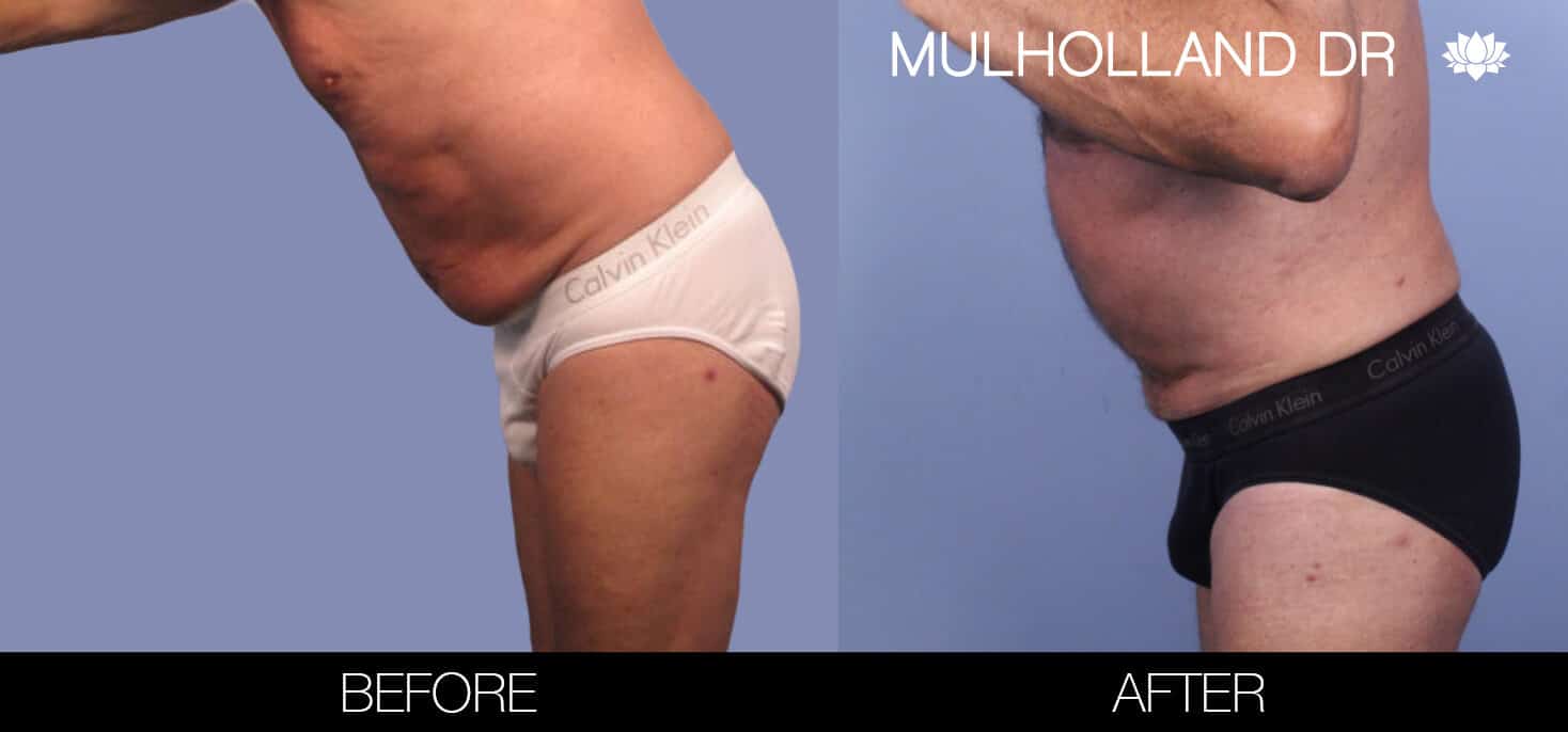 Male Tummy Tuck (Belt Lipectomy) - Before and After Gallery – Photo 43