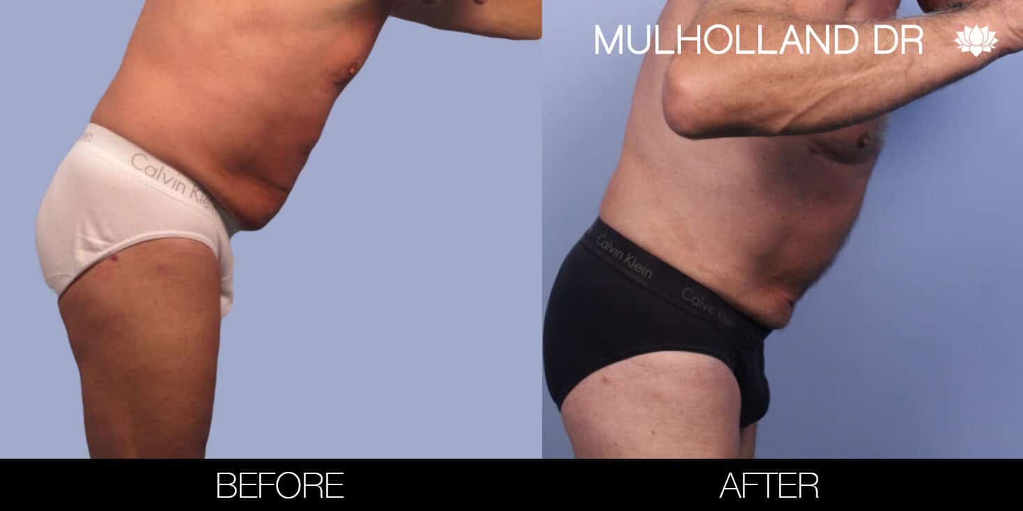 Male Tummy Tuck (Belt Lipectomy) - Before and After Gallery – Photo 44