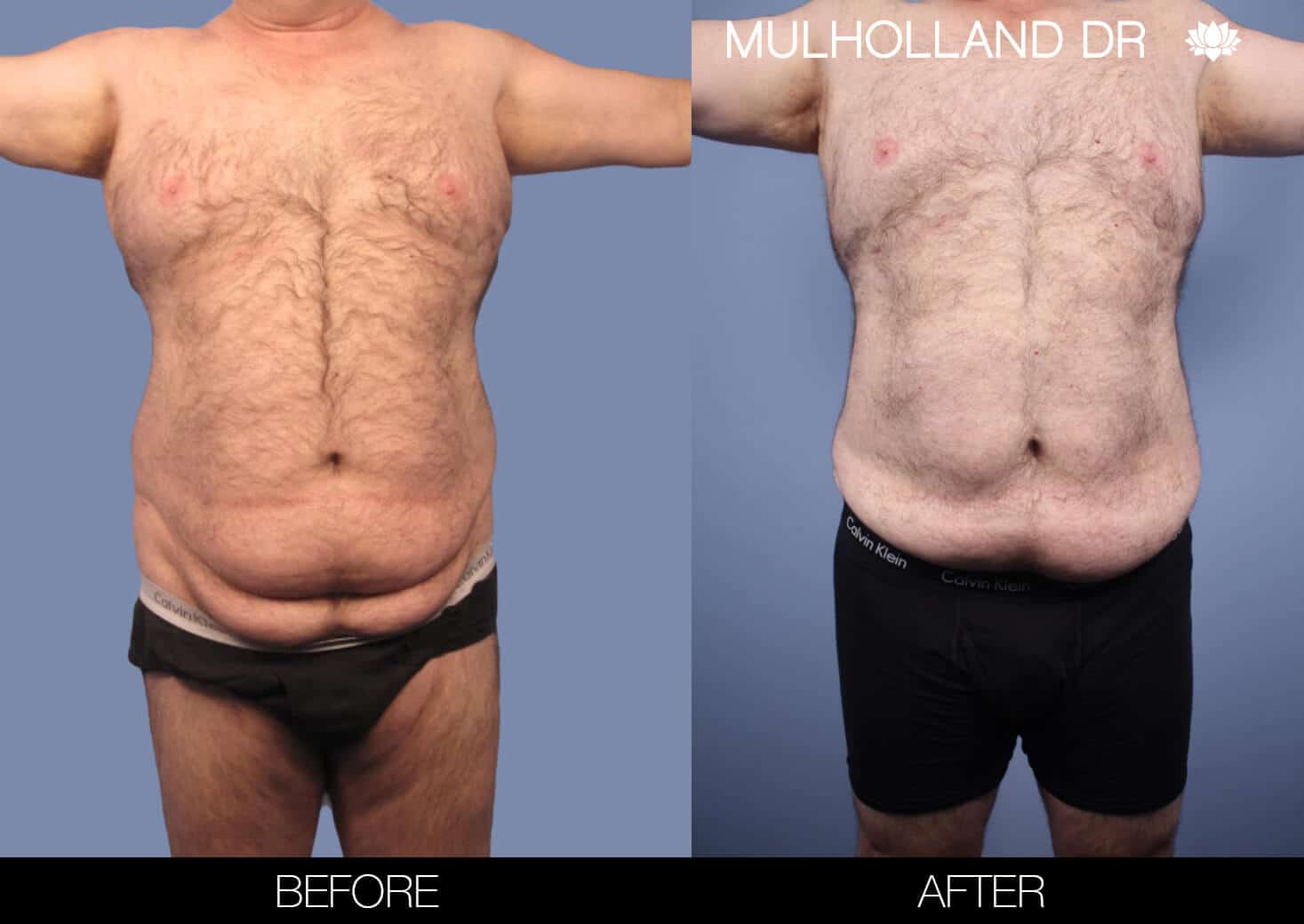Male Tummy Tuck (Belt Lipectomy) - Before and After Gallery – Photo 45