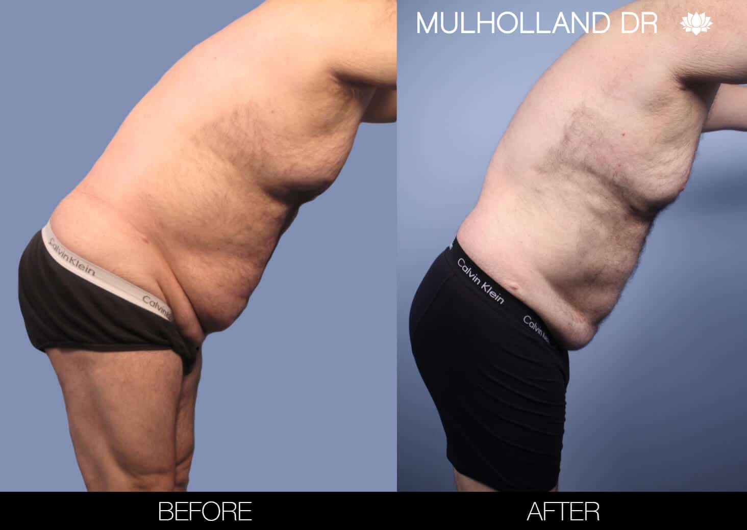 Male Tummy Tuck (Belt Lipectomy) - Before and After Gallery – Photo 46