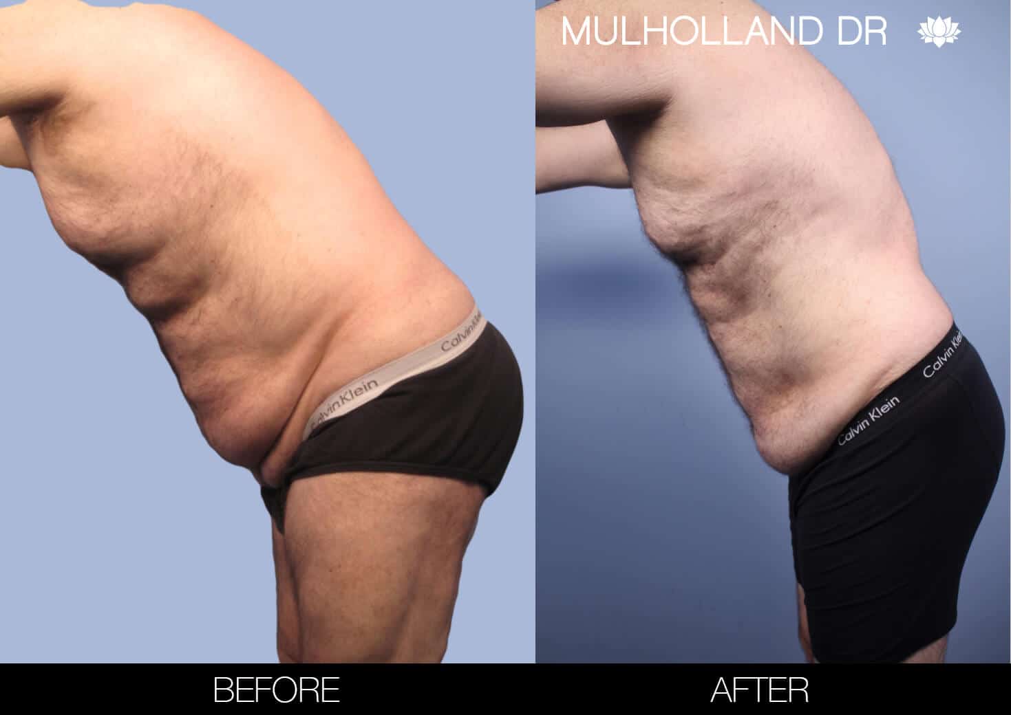 Male Tummy Tuck (Belt Lipectomy) - Before and After Gallery – Photo 47